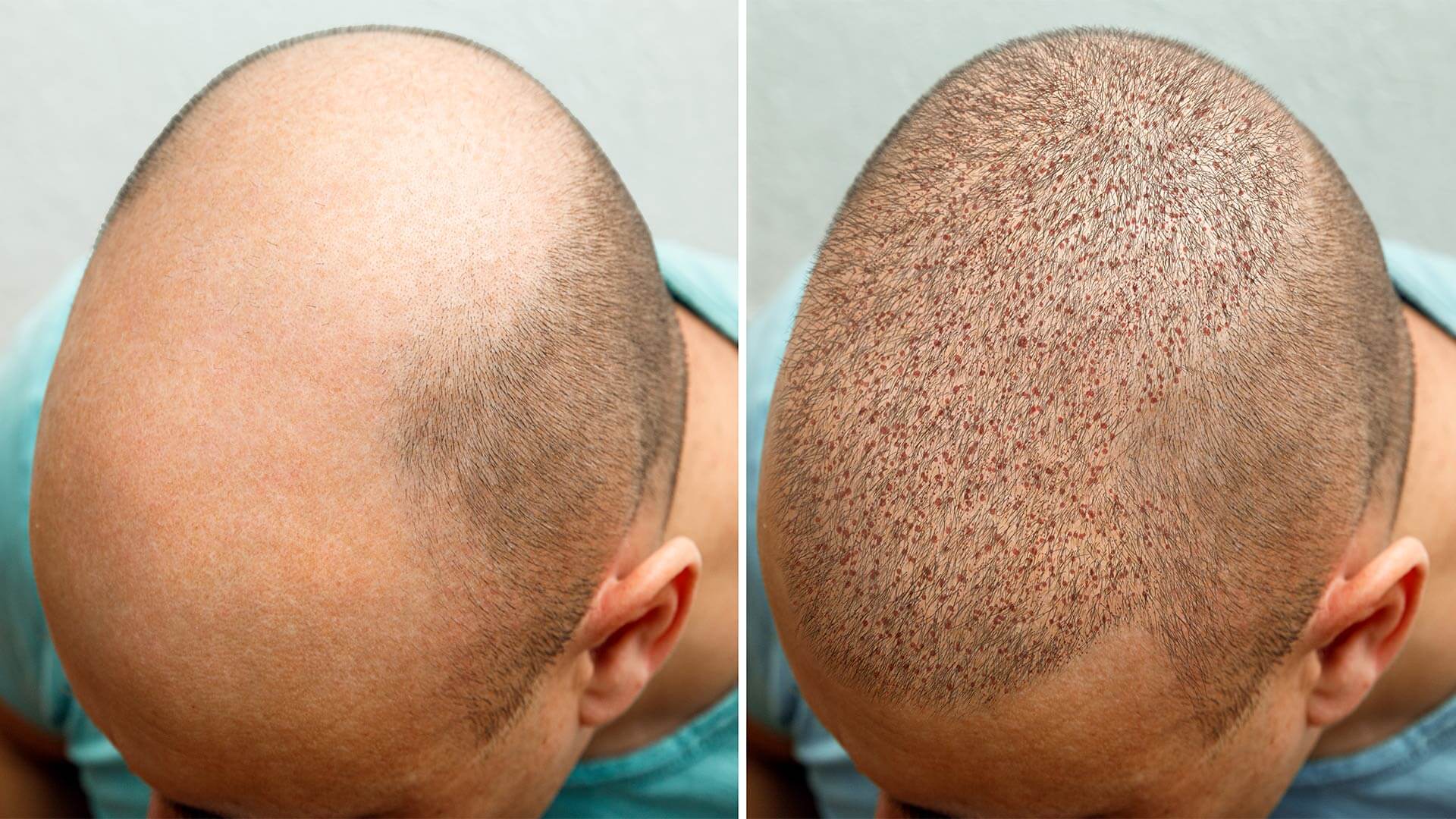 Hair Restoration

Hair transplants can be effec... main image
