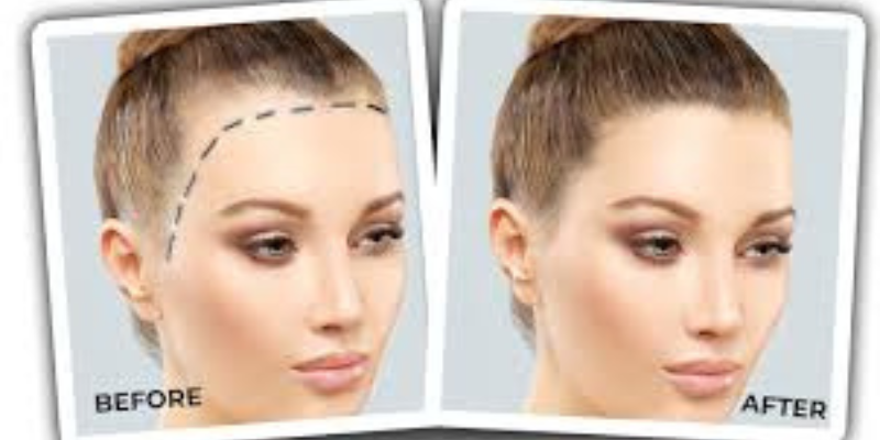 Hair transplant for women

Hair transplants can al... main image