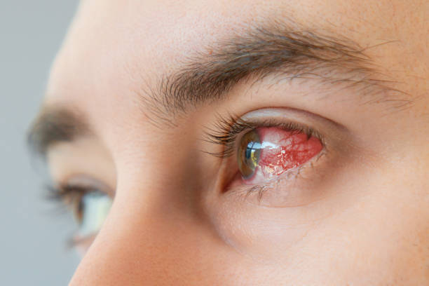 Cornea Treatment at Isha Netralaya The cornea i... main image