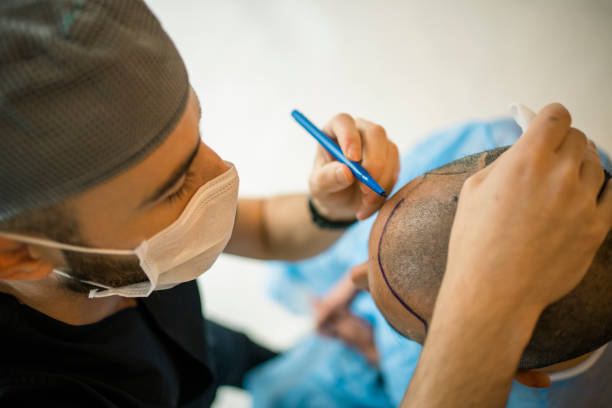 Best Hair Transplant