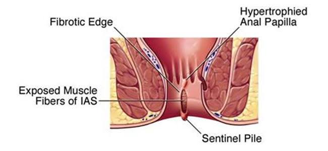 Sentinel piles are common, usually harmless,  g... main image