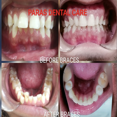 
Case of crowded and protruded teeth are treate... main image
