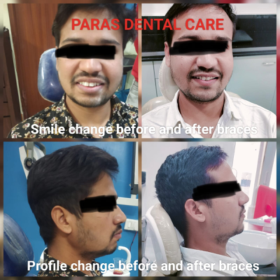 Facial profile change after ceramic braces or O... main image
