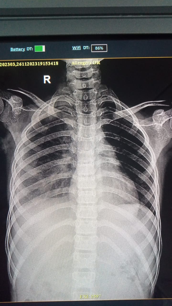 xray showing right pleural effusion, pt present... main image
