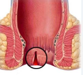 Fissure Care at Dr. Phapale Hospital - Your Pat... main image