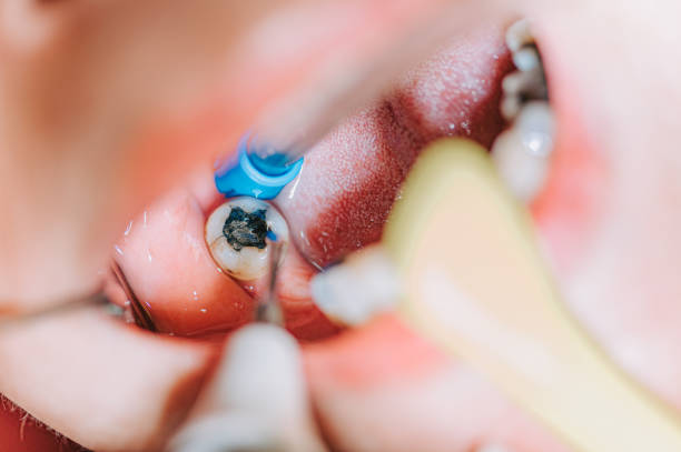 Mastering Painless RCT at Dr. Rai's Dental Avenue ... main image