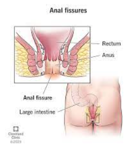 Laser Surgery for Piles and Fissures in Vasai A... main image
