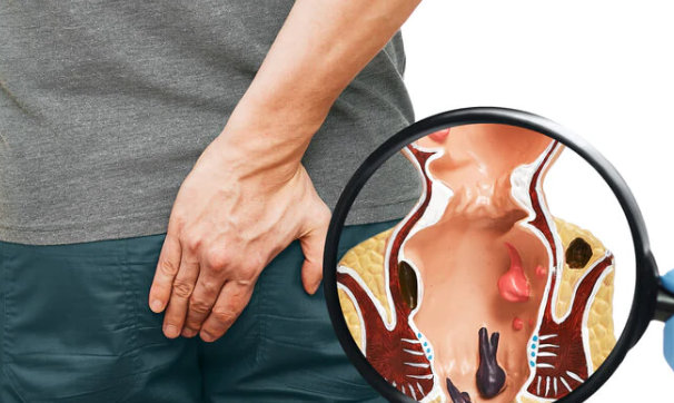Recognizing Early Signs of Piles: A Guide by Dr... main image