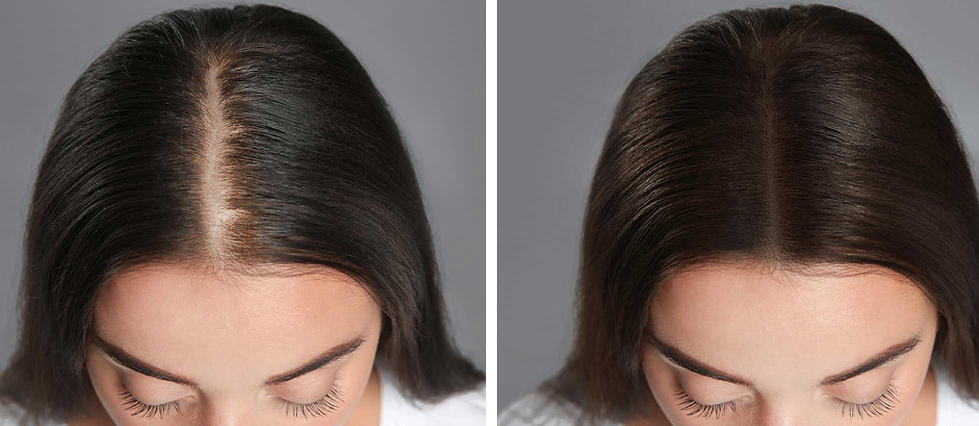 HAIR REPLACEMENT

Hair replacement refers to va... main image