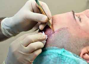 HAIR TRANSPLANT SURGERY

Hair transplant surgery i... main image