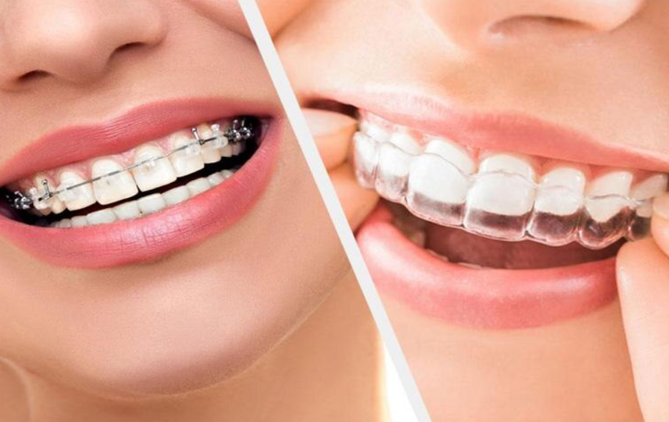 Crafting Beautiful Smiles: Braces, Dental Caps, an... main image
