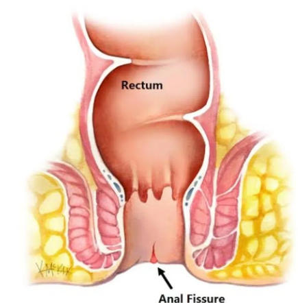Fissure Treatment Excellence at Dr. Phapale Hos... main image