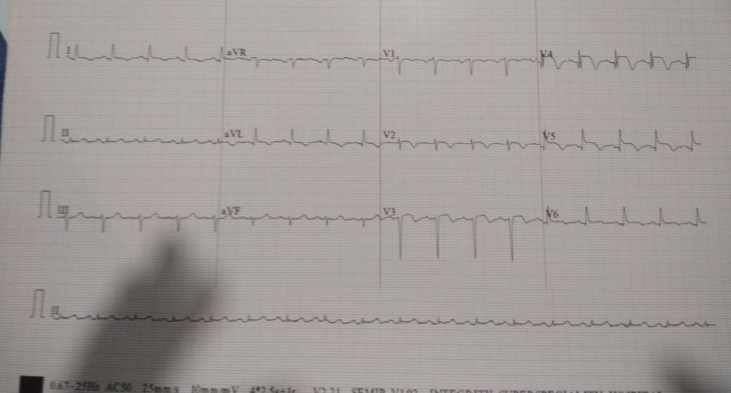ECG is important diagnostic tool in heart attack c... main image