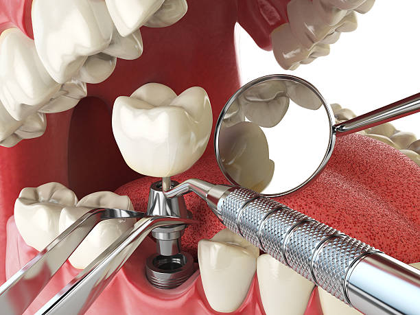 Dental Implant Surgery: A Permanent Solution with ... main image