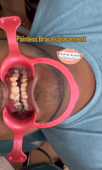 💎Procedure for the Braces placement for your bi... main image