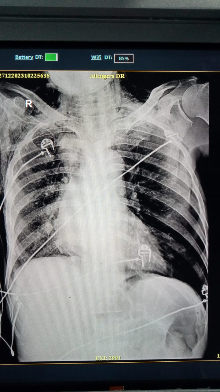 Air in chest is critical condition , its called pn... main image