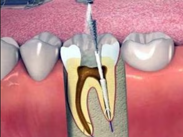 Comprehensive Painless RCT Solutions at Dr. Rai's ... main image