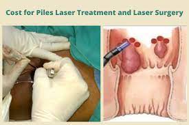 Laser Surgery for Piles: A Revolution in Treatm... main image