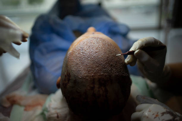 Unlocking Confidence: Top-Rated Hair Transplant... main image