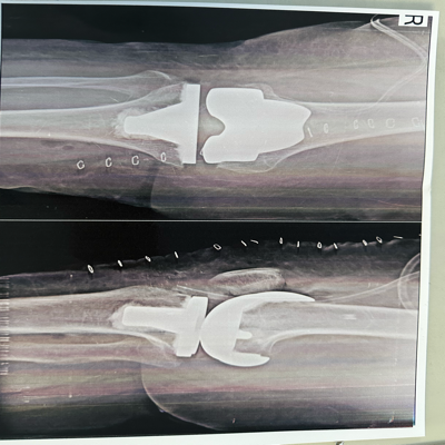 Best joint replacement centre in pune main image