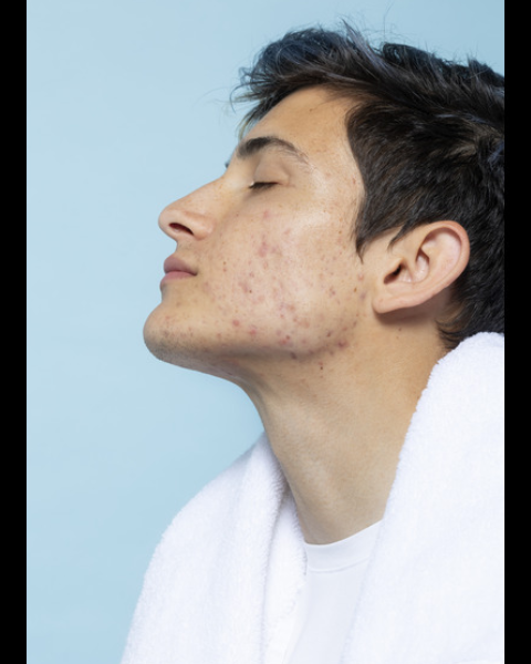 acne prone skin
