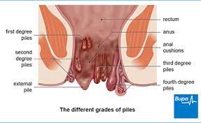 Holistic Approach to Piles Care with Ayurvedic ... main image