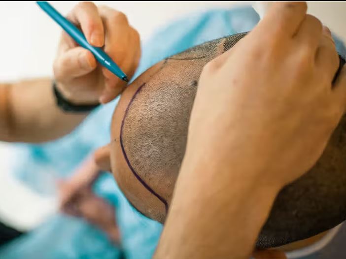 Hair Clinic Excellence: Eloraa Cliniq's Experti... main image