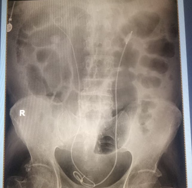 Gaseous disention of abdomen can be due to obstruc... main image