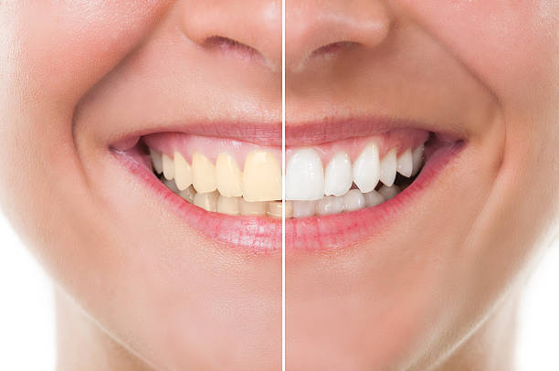 Achieve a Radiant Smile with Teeth Whitening at Dr... main image