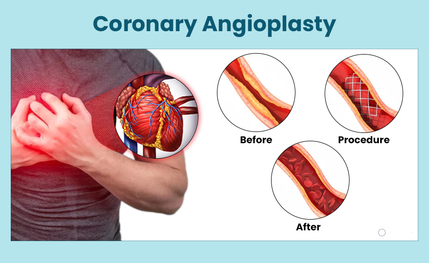 Angioplasty is performed for various reasons, a... main image