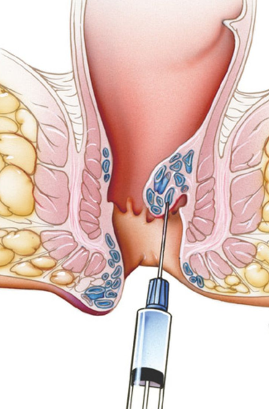 Piles Injection Treatment at Dr. Phapale Hospit... main image