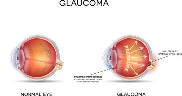 Battling Glaucoma: Green City Eye Clinic's Pion... main image