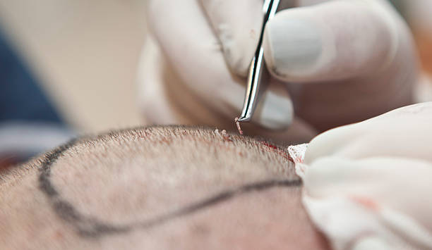 Hair Transplant Near Me: Eloraa Cliniq's Conven... main image