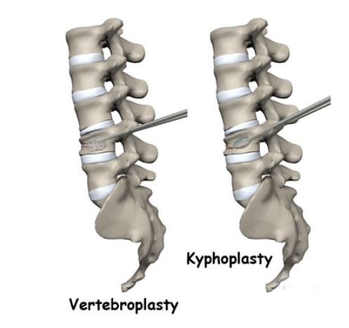 Vertebroplasties and Kyphoplasties: A Breakthro... main image