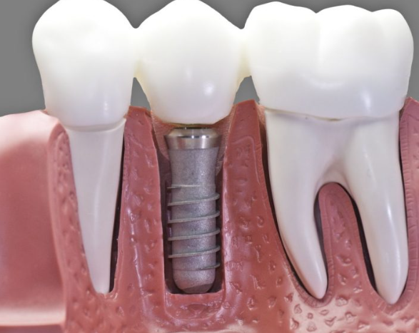 Dental Implant Center in Jaipur: Smile Confiden... main image
