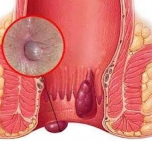 Fissure Treatment Excellence at Dr. Phapale Hos... main image