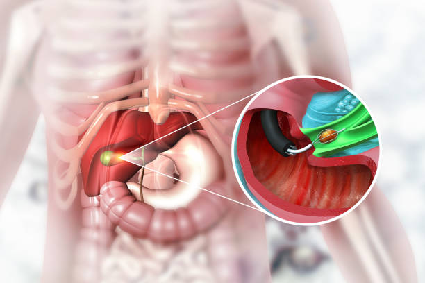 Laparoscopic Gall Bladder Removal - Expertise a... main image
