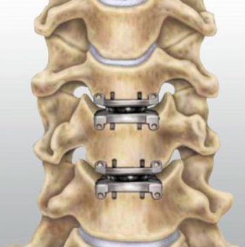Cervical Disc Replacements at Ortho Relief, Nag... main image