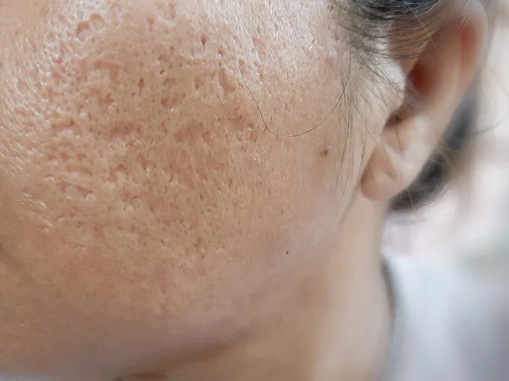 🌟 **Acne Scar Solutions by Dr. Narendra Nikumbh... main image