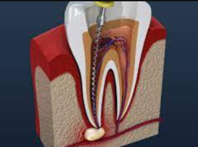 Experience Painless RCT at Dr. Rai's Dental Avenue... main image