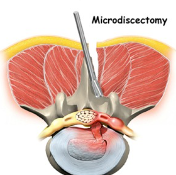 Advancing Surgical Precision: Microdiscectomies... main image