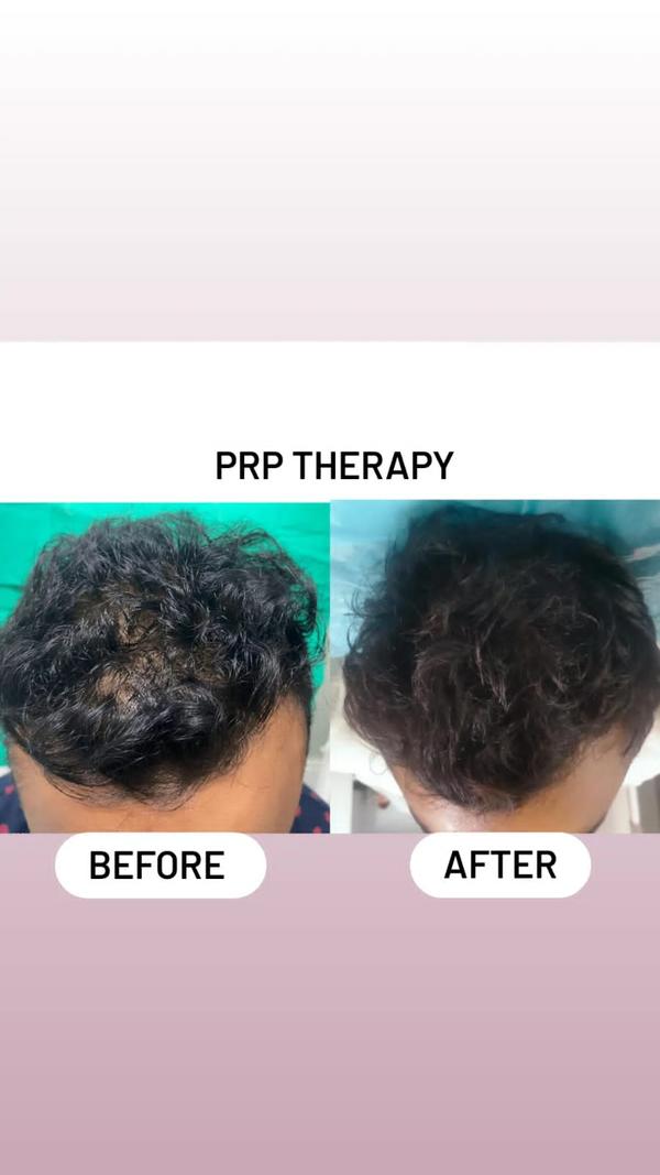 Reclaiming Confidence with the Best Hair Transp... main image