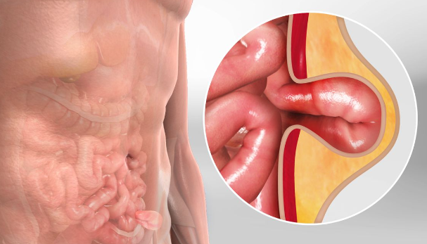 Inguinal Hernia Mastery: Dr. Rajiv Manek's Trus... main image