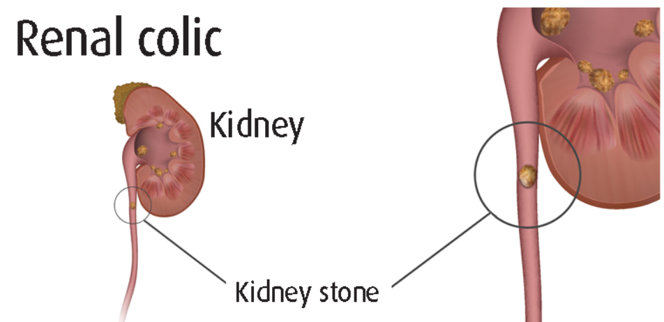 Renal Colic and Ureteric Colic - Unraveling Exp... main image
