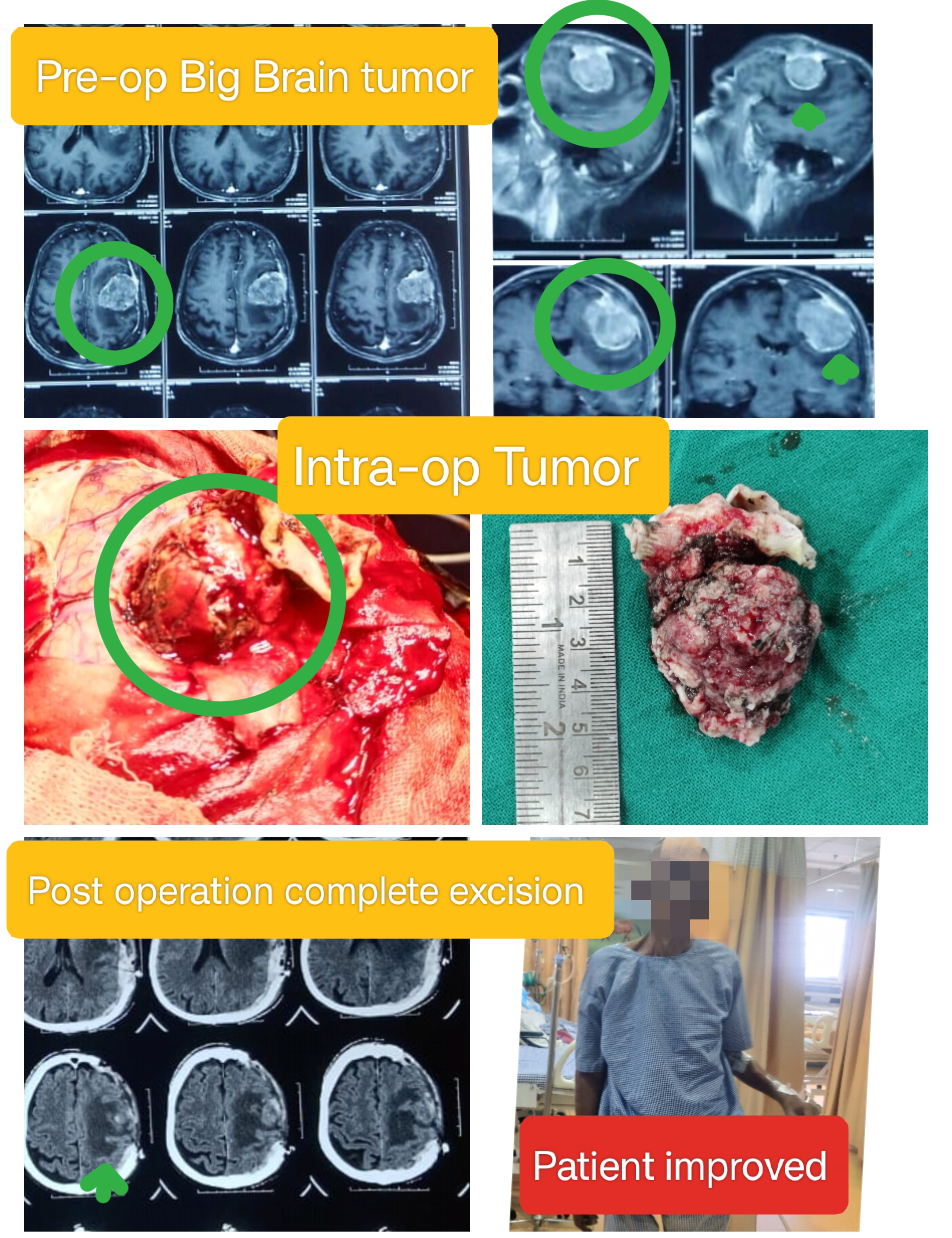 A 60 year old patient suffering from Right Hemipar... main image