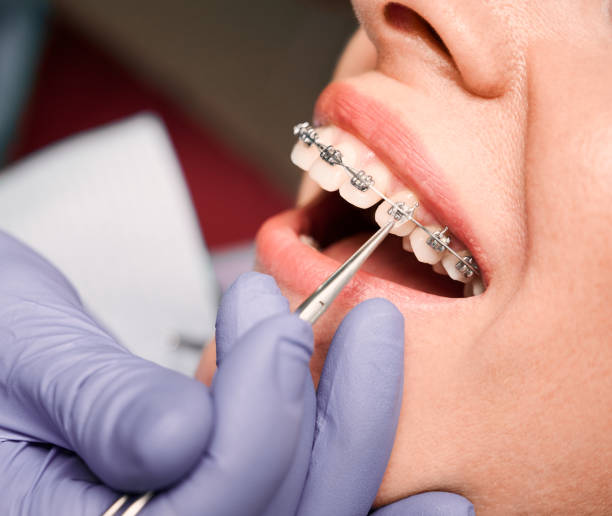 Perfect Your Smile: Braces, Dental Caps, and Zirco... main image