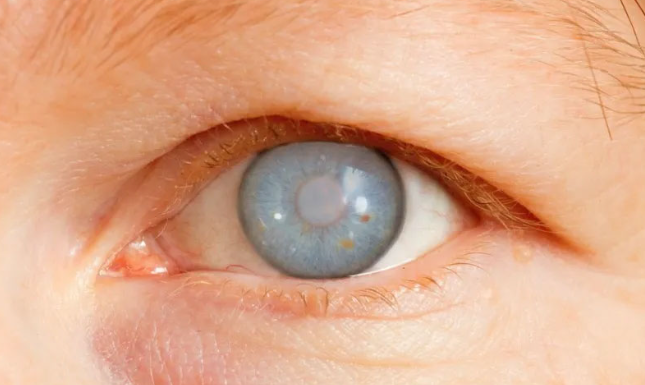 Understanding Glaucoma: Causes, Symptoms, and Trea... main image