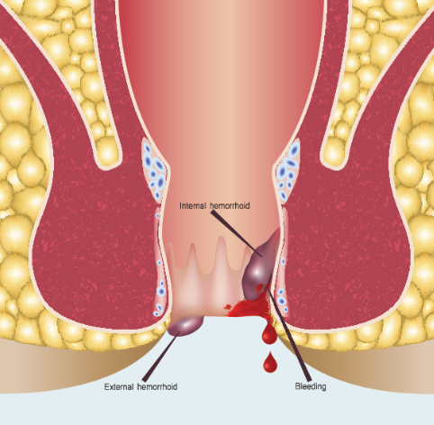 Choosing the Right Treatment Approach for Piles... main image