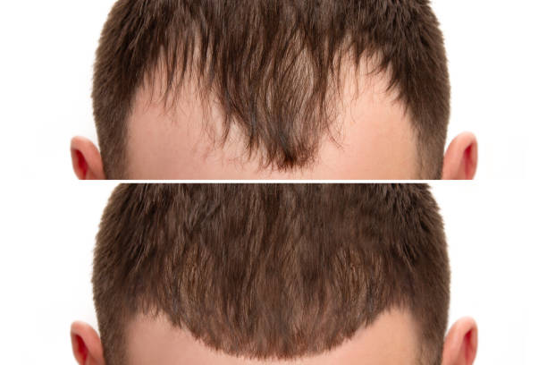 Defeating Hair Fall: ELORAA CLINIQ's Comprehens... main image