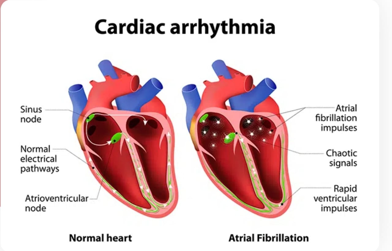 Arrhythmia refers to a group of conditions char... main image
